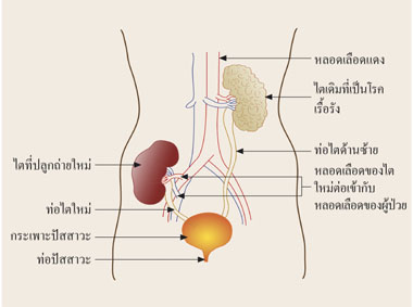 โรคไต